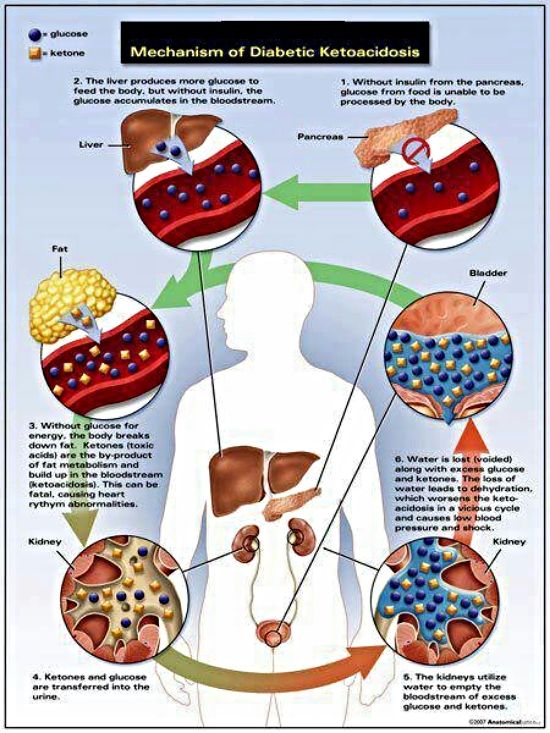 Info Ketones, Diabetic Ketoacidosis (DKA), and Blood Ketone Meters